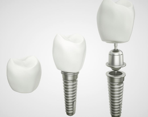 莆田皓雅口腔门诊部吴金杰种植牙能相信吗？医生经验丰富技术好，值得信赖！ 