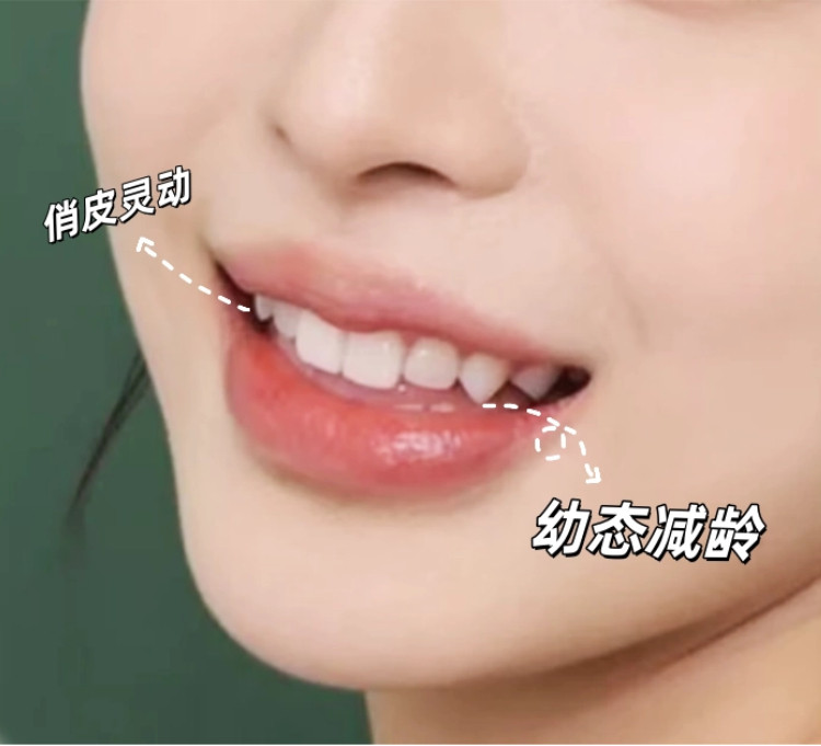 绝了！！做完牙齿贴面才知道&ldquo;幼态笑&rdquo;真的可以后天养成！！！案例图片 2