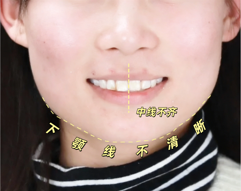 ✨笑出自信，侧颜杀我有了！🦷💥案例图片 2