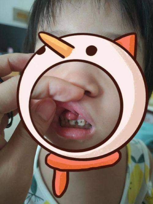 山西省兒童牙齦炎費用多少錢？一文搞懂影響費用的因素，看完不再糊塗！ 