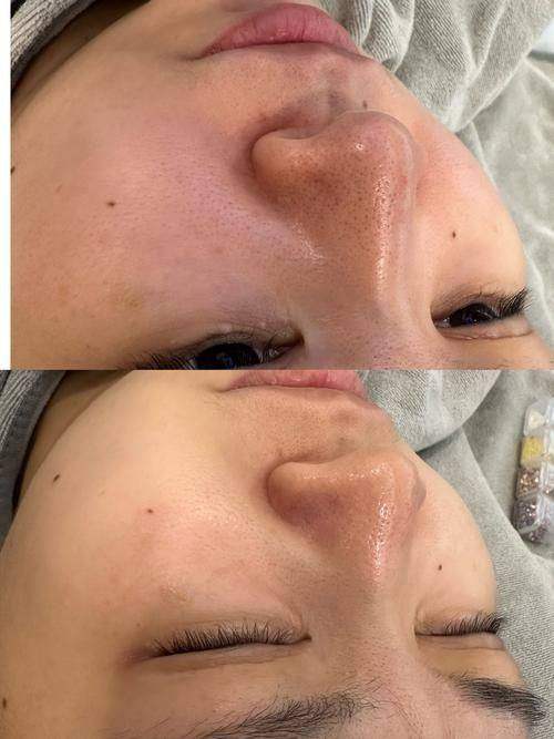 深圳米兰柏羽医疗美容医院沈敞原光子美白嫩肤可信吗？专业医生技术靠谱效果有保障！ 