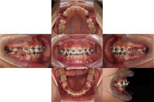 影響隱形托槽矯正費用的因素