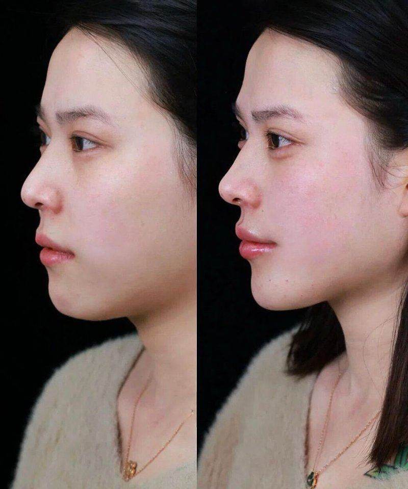 上海星和医疗美容医院的热门项目之鼻部整形