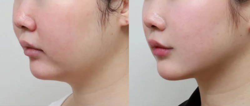 张家口维多利亚医疗美容医院:割双眼皮技术领跑