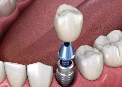 太原盛美口腔門診部值得信賴嗎？看患者真實評價，技術服務雙優很靠譜！ 