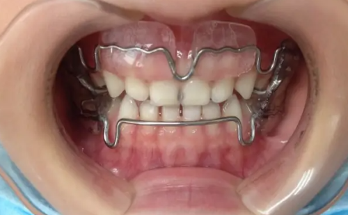 天津宝坻东方口腔门诊部：透明的项目价格