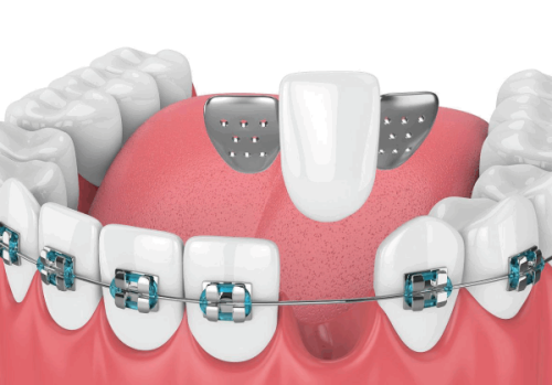臨沂壹顆芽口腔醫院鑲牙/根管治療價格表：修復類項目，透明公開！