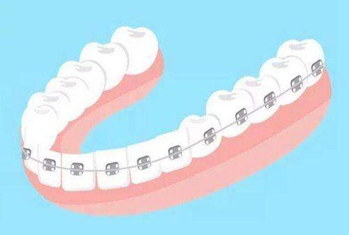 臨沂壹顆芽口腔醫院補牙/拔牙價格表：基礎治療，低至“一杯奶茶錢”！