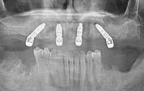 种植牙市场价格乱象与北京中腾口腔医院的应对