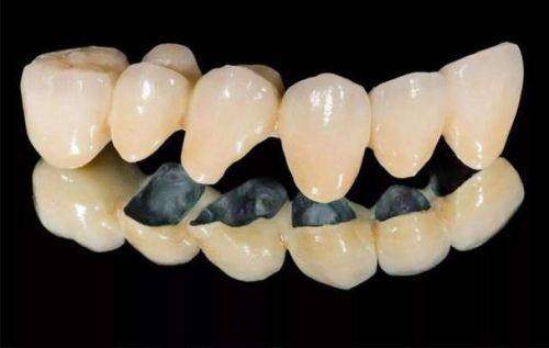 山西省贵金属烤瓷牙价格一览表2026，让你清楚了解当地该类烤瓷牙大概价格情况！ 