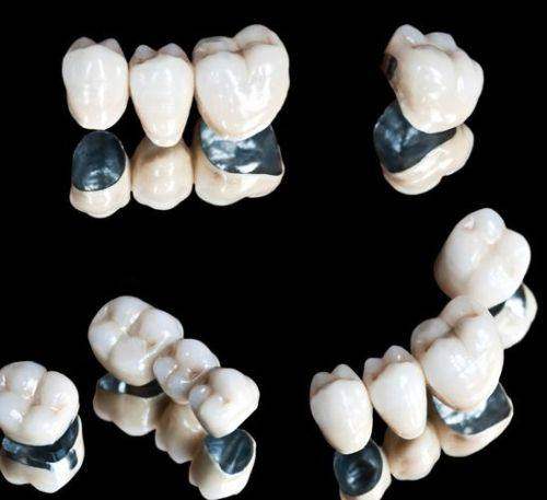 不同因素对山西省贵金属烤瓷牙价格的影响