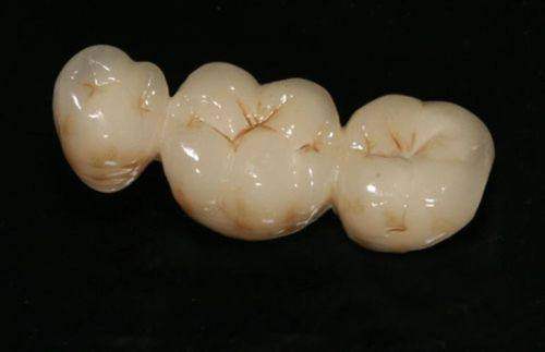 选择贵金属烤瓷牙的注意事项