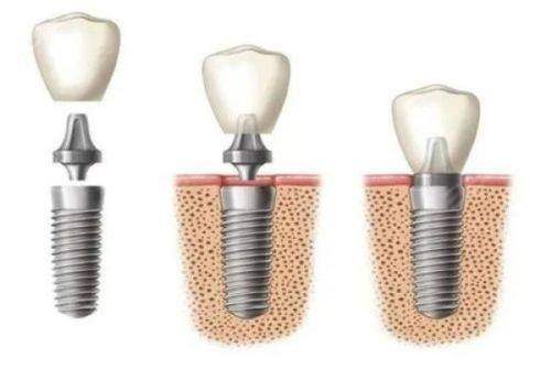 北京邓洪江优诚口腔诊所怎么样？真实患者分享就医体验与效果分析