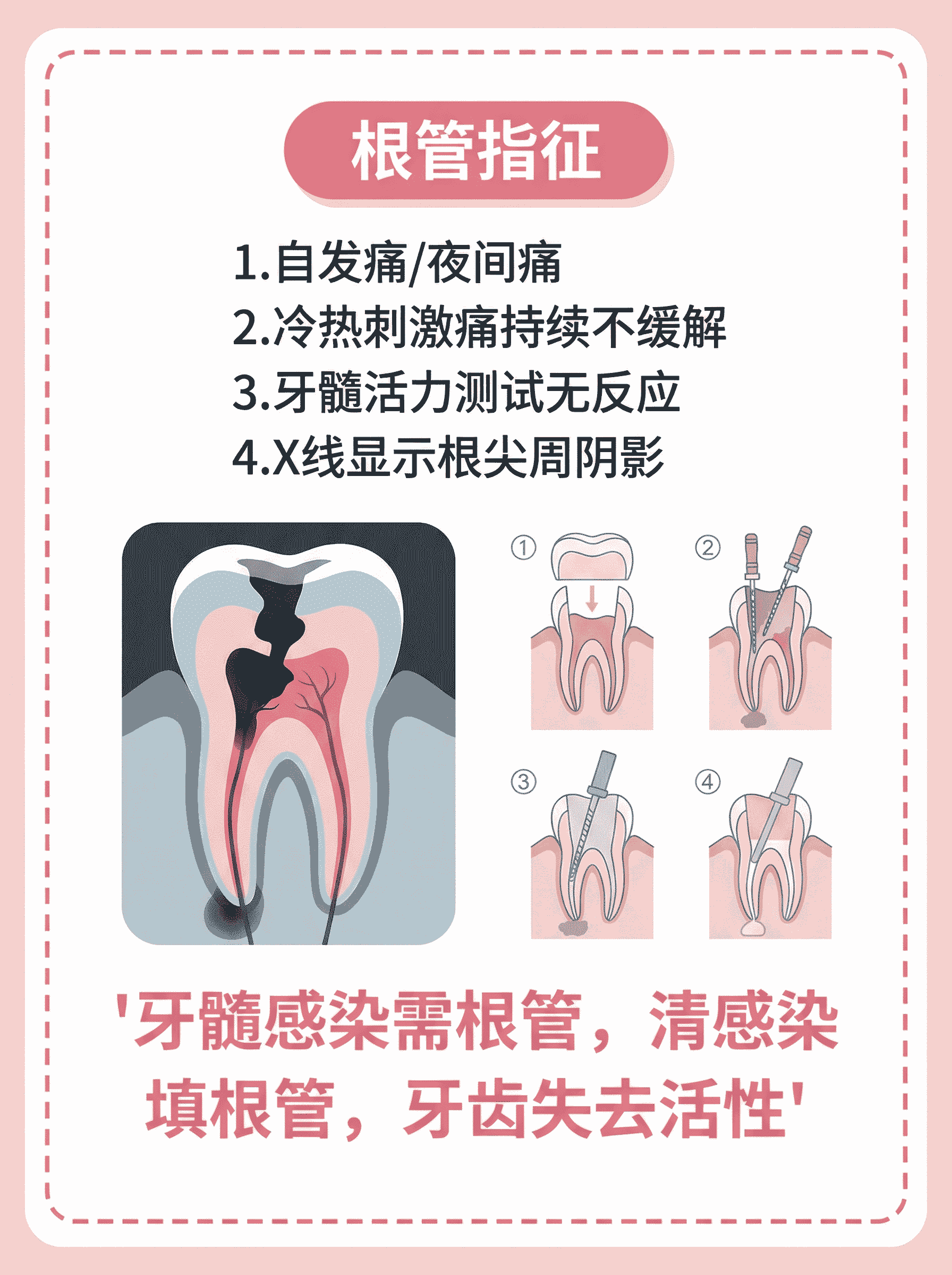 蛀牙别急！先花1分钟分清你是补牙还是根管案例图片 3