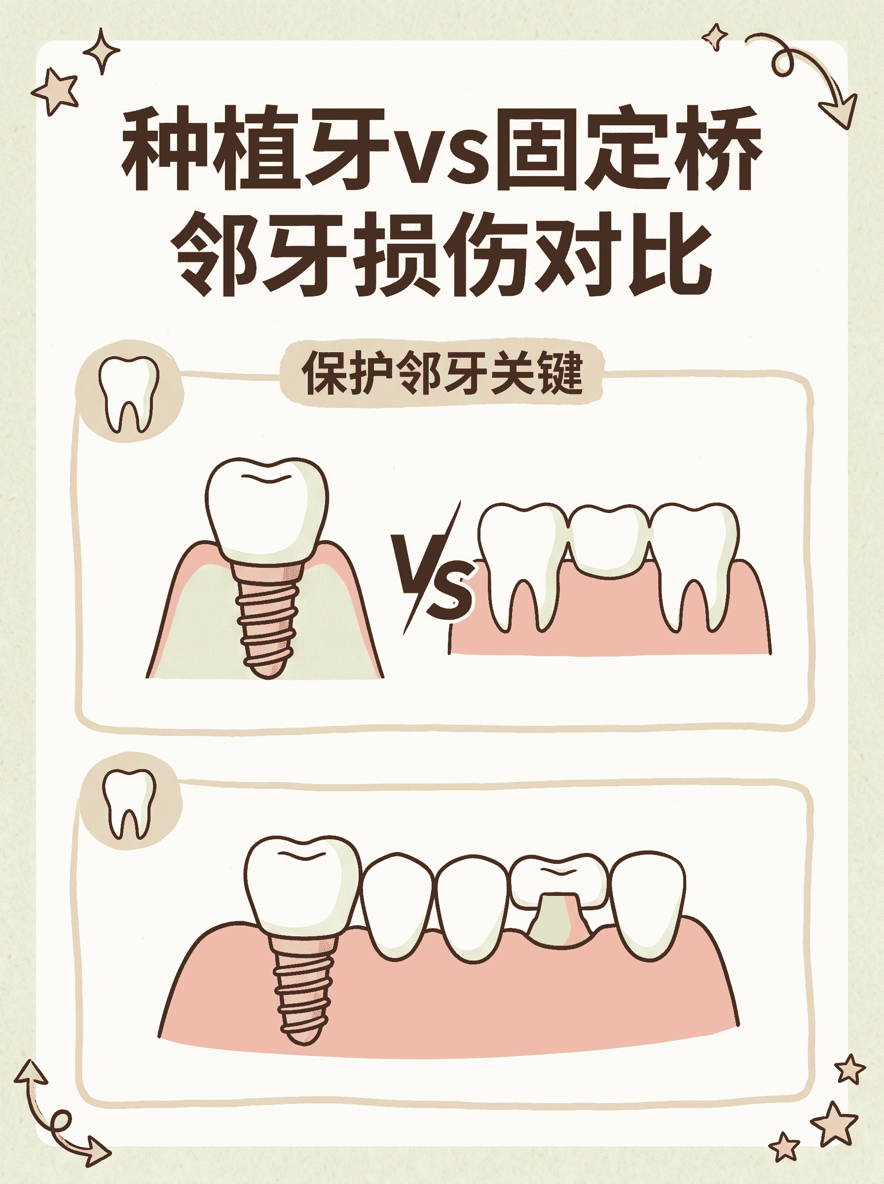 种植牙vs固定桥 邻牙损伤对比