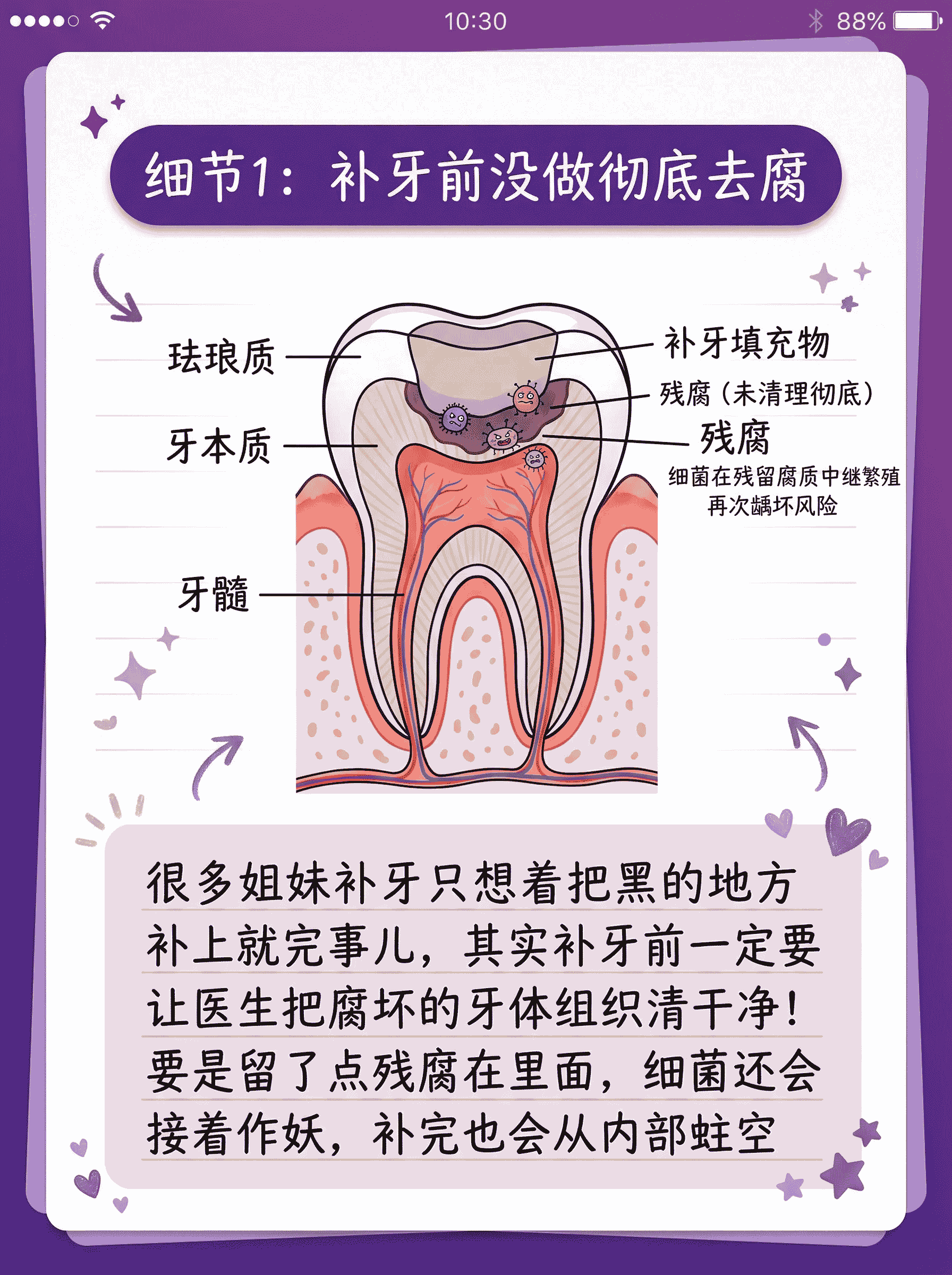 补过的牙又蛀？3个细节别漏案例图片 2
