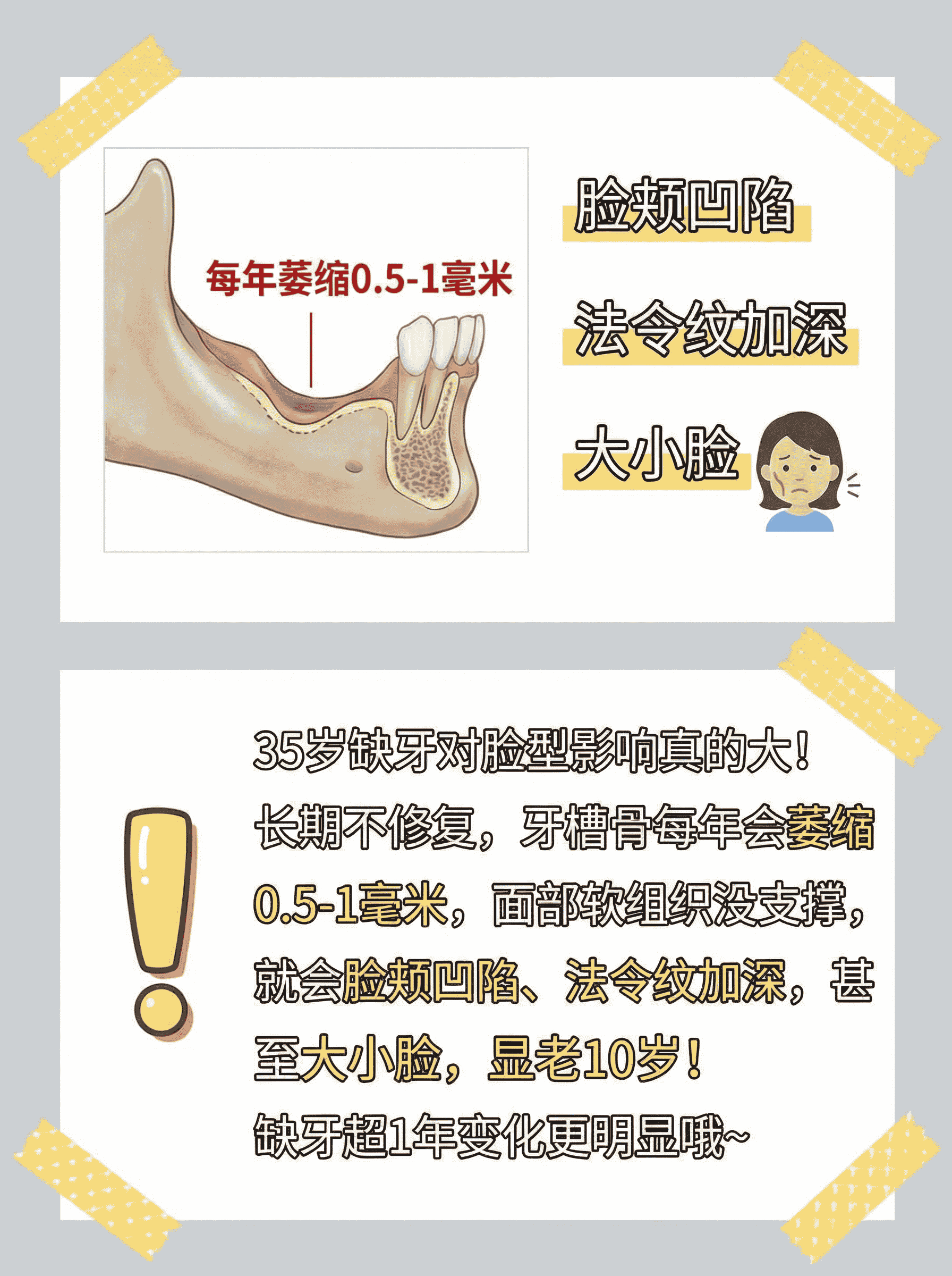 35岁缺牙脸垮像45？9600元种牙回春啦案例图片 2