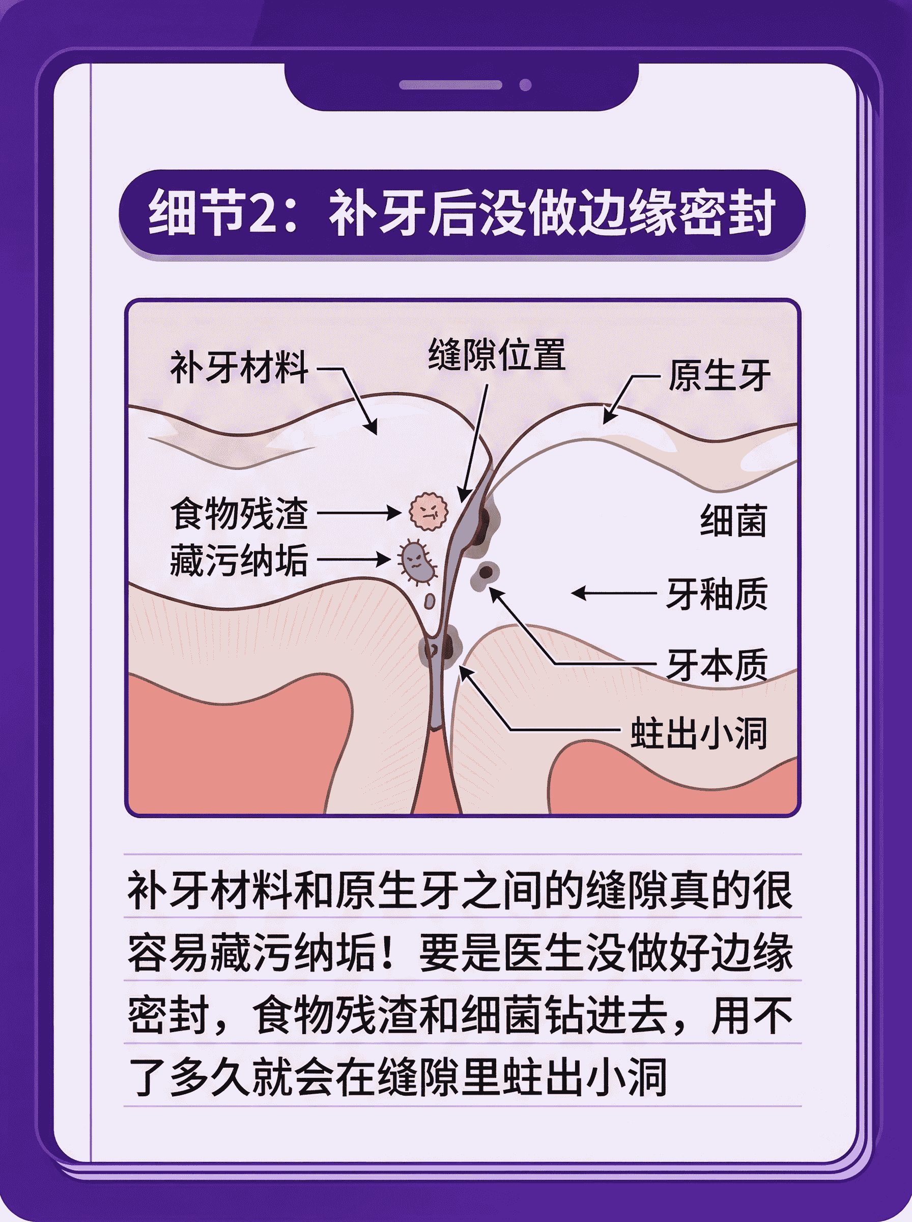 补过的牙又蛀？3个细节别漏案例图片 3
