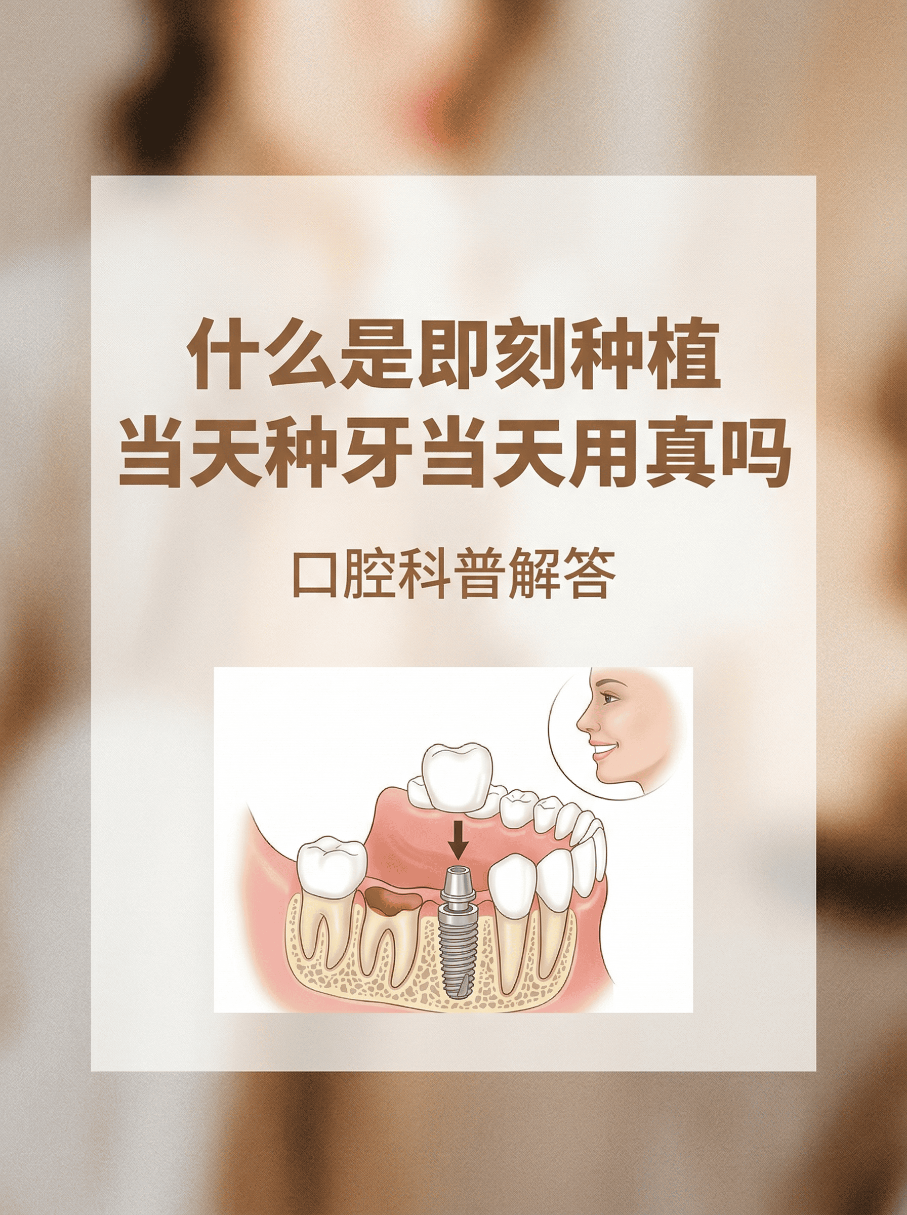 什么是即刻种植？当天种牙当天用真吗？