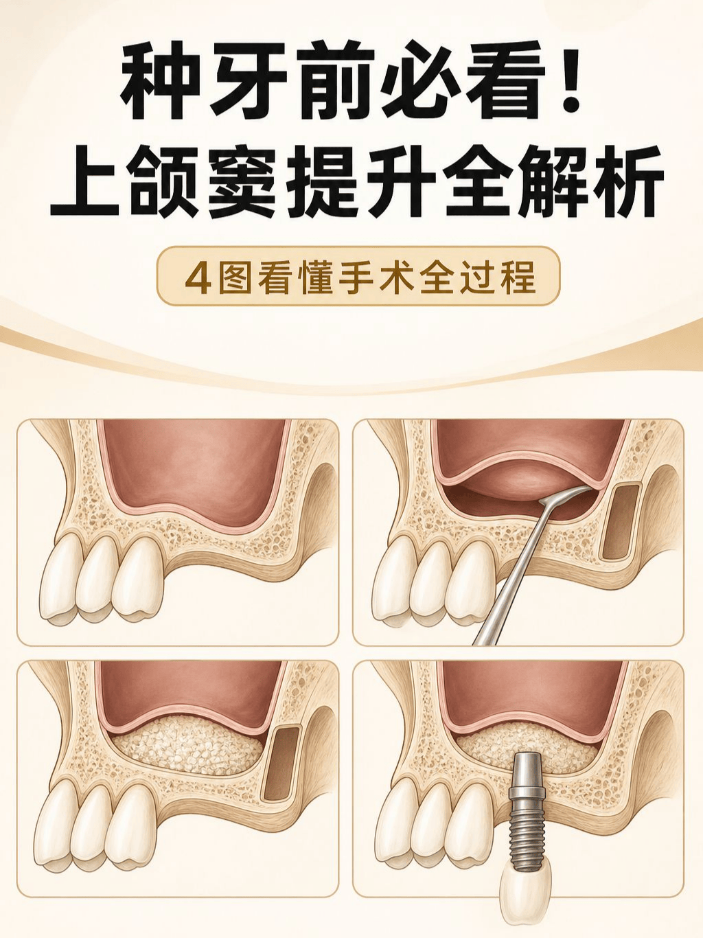 上颌窦提升到底是什么？种牙人必看懂案例图片 1
