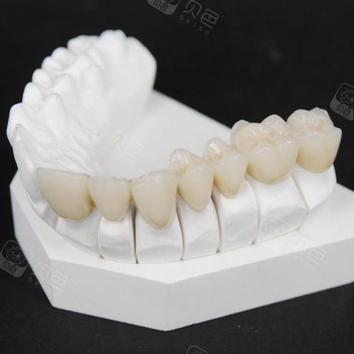 【全冠牙爱尔创二氧化锆牙冠】仅售1580元,价值2500