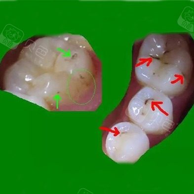 【牙周上药派力奥】仅售999元,价值2110元牙周病治疗套餐!