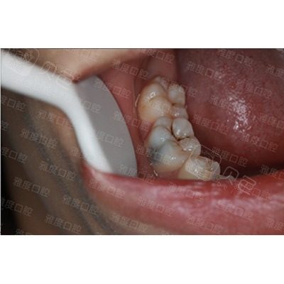 昆明雅度口腔后磨牙树脂充填案例