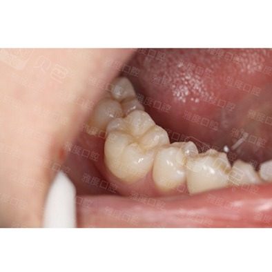 昆明雅度口腔后磨牙树脂充填案例