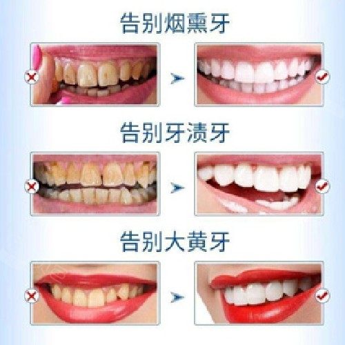 牙齿美白仅售980元价值2300元单人美国进口牙齿美白套餐节假日通用