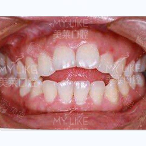 美莱口腔门诊怎么样?前牙开合矫正方法是什么,效果如何? - 泉州美莱口