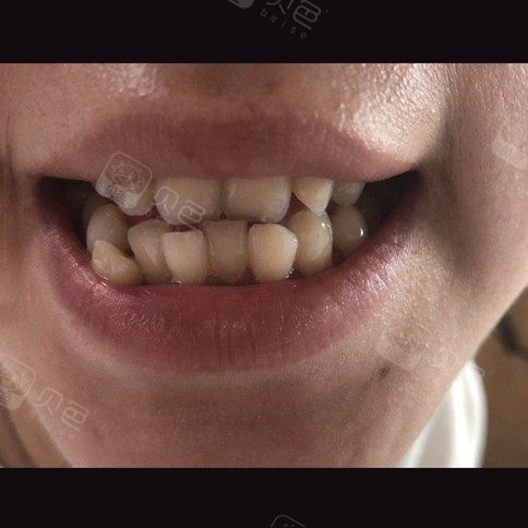 牙齿不咬合,下牙牙列不齐要拔牙吗?