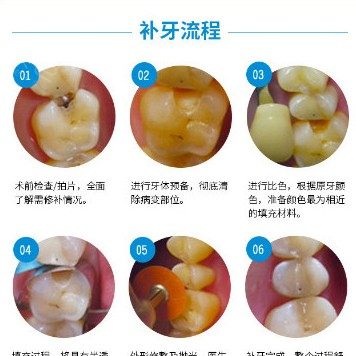 【补牙树脂美学修复】216元瑞士卡瑞斯玛纳米补牙,免费停车位,男女