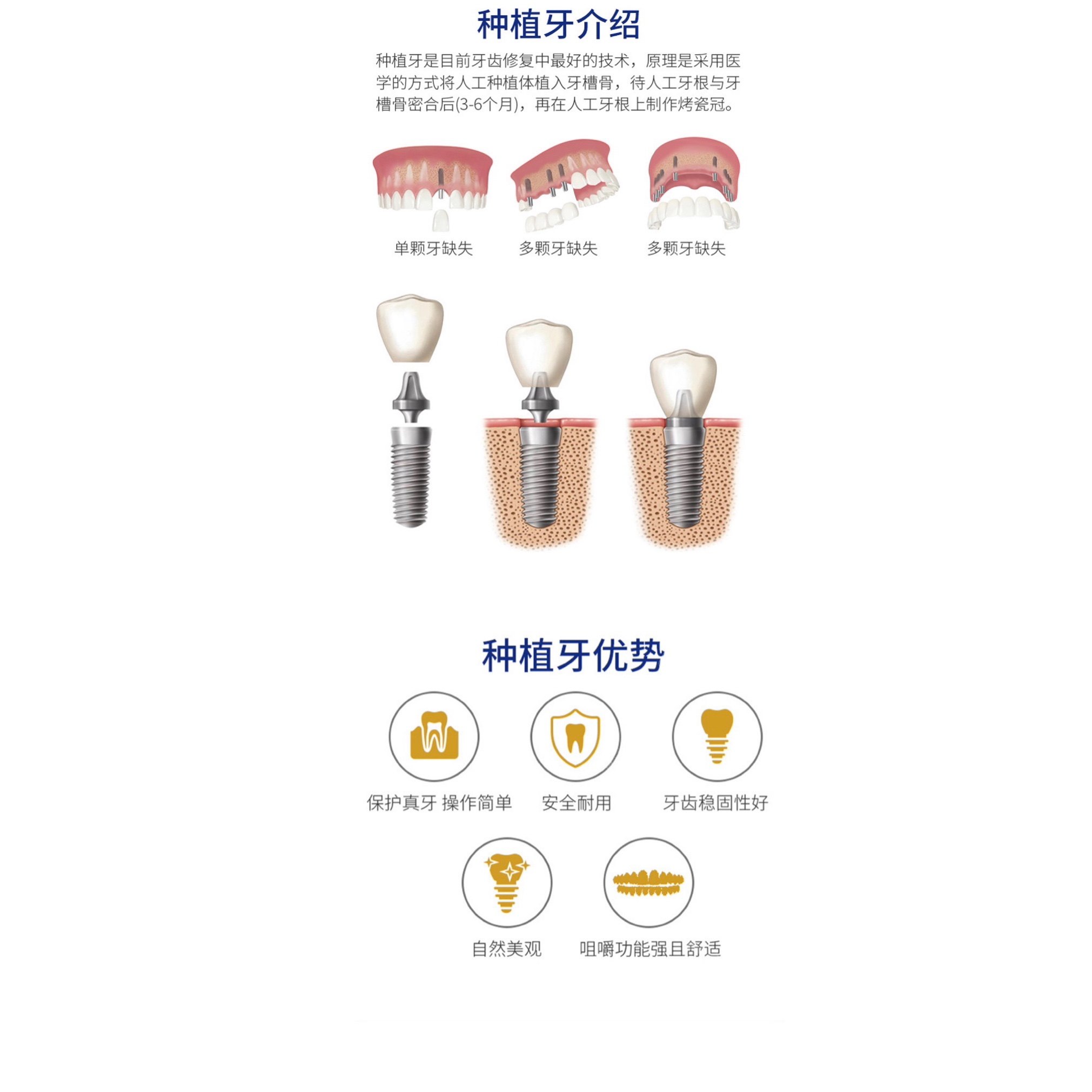 【种植牙】德国种植牙套餐 - 杭州德贝艾尔口腔门诊部(联庄店) - 贝色口腔