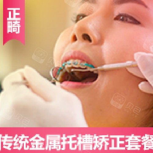 【牙齿矫正国产传统矫正（金属）】{金属托槽}传统金属矫正套餐 · 贝色公开展示图片
