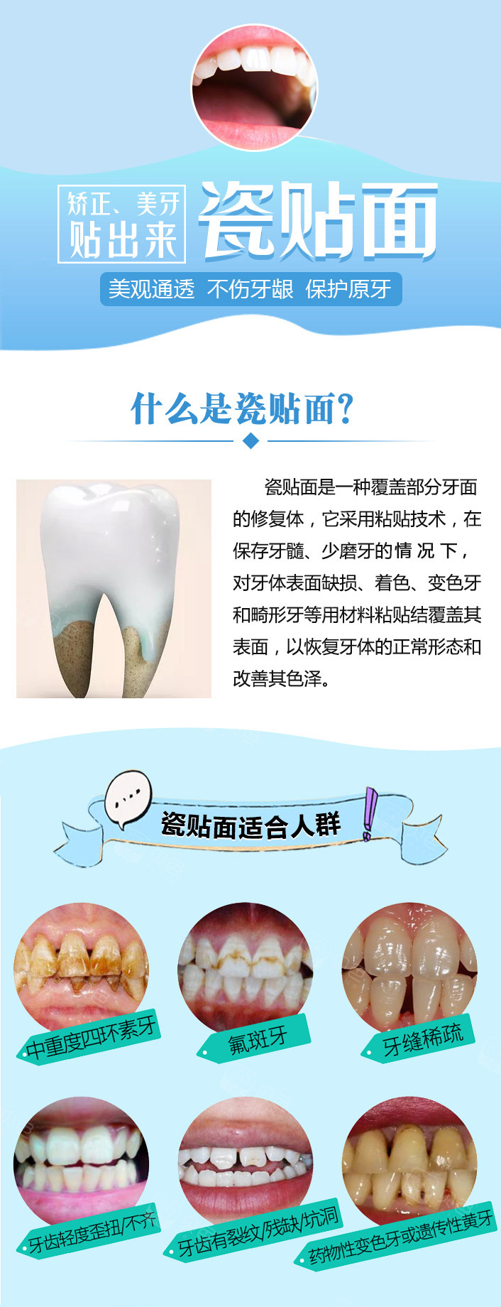 牙齿贴片美加贴面广州广大口腔美加全瓷贴面美白牙齿改善稀疏氟斑牙