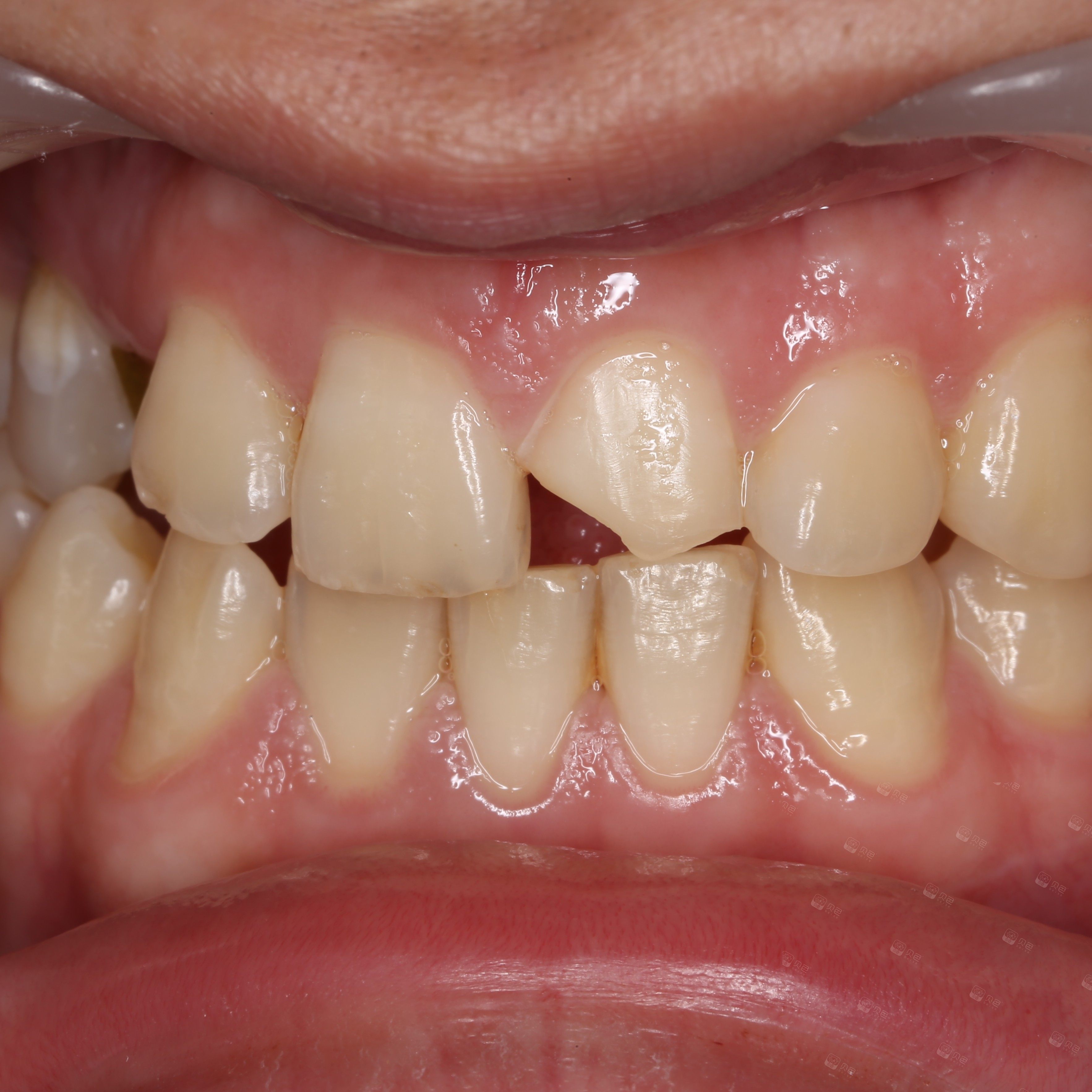 南昌辉煌口腔医院美学树脂修复牙体损失案例