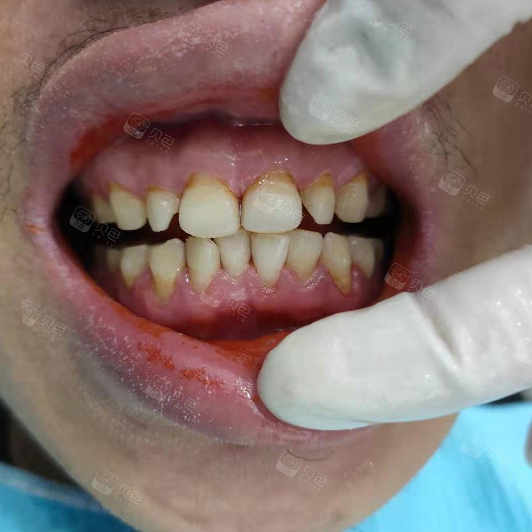 【槟榔牙喷砂洁牙】对比案例