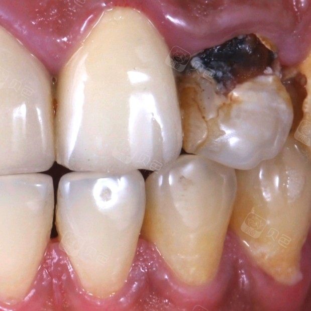 【全瓷冠门牙修复】对比案例