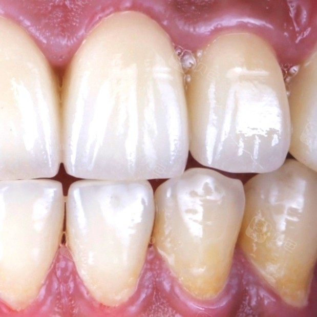 【全瓷冠门牙修复】对比案例