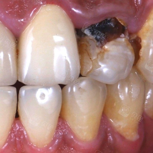 海南微笑口腔医院_牙齿案例 - 贝色口腔