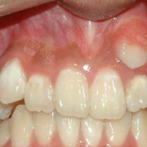 大连卓尔美笑口腔(海滨路店)多生牙矫正案例