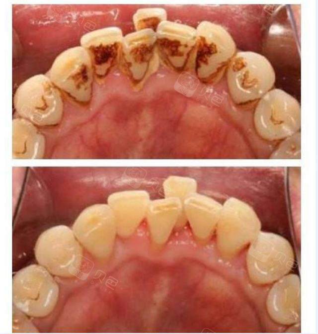 【洗牙超声波洁牙】单人超声波洁牙 抛光,上药套餐(轻度) - 贵阳美艺