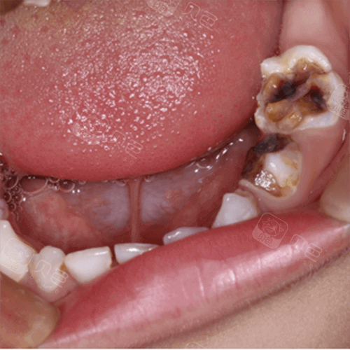 牙齿龋坏照片