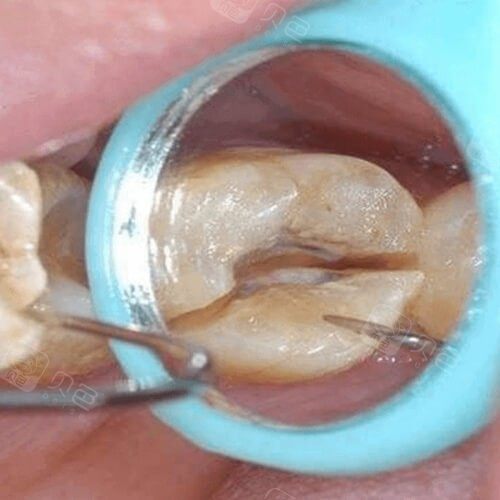 1000元 口腔项目  根管治疗 恢复时间  30天 收藏 说起牙齿治疗,憾噜