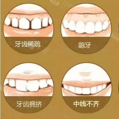 一个牙医的良心忠告:这5类人不能做牙齿整形!