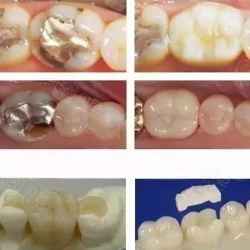 不同材质嵌体修复效果图