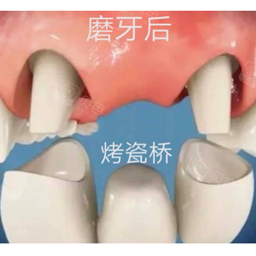 如果门牙缺失怎么修复?