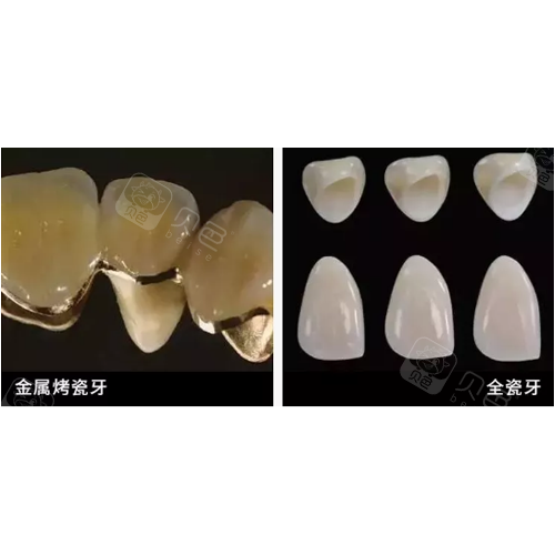 烤瓷牙和全瓷牙哪个好?有什么区别吗?哪个寿命长?