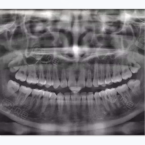 牙片有哪些种类和牙ct有什么区别什么情况下要拍牙齿ct