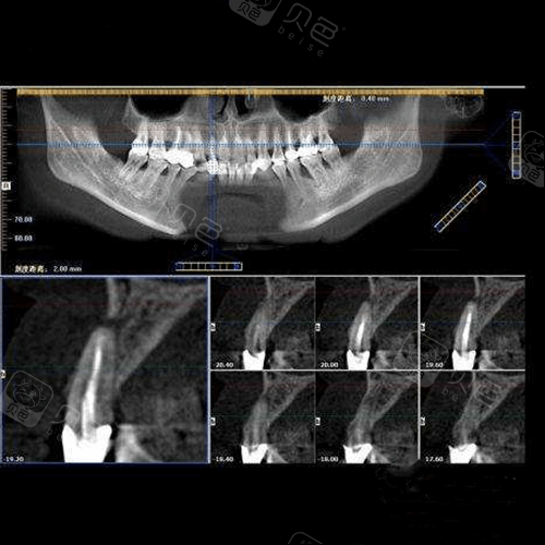 牙片有哪些种类和牙ct有什么区别什么情况下要拍牙齿ct